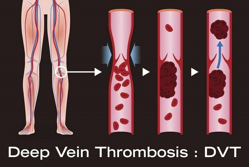 ترومبوز ورید عمقی يا DVT نیز بعلت ایجاد اختلال گردش خون